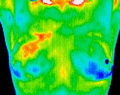 Breast Thermography | Thermal Body Scan